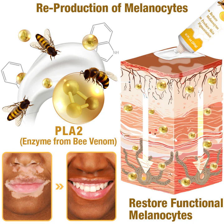 LOVILDS⢠BeeVenom Vitiligo Treatment Cream
