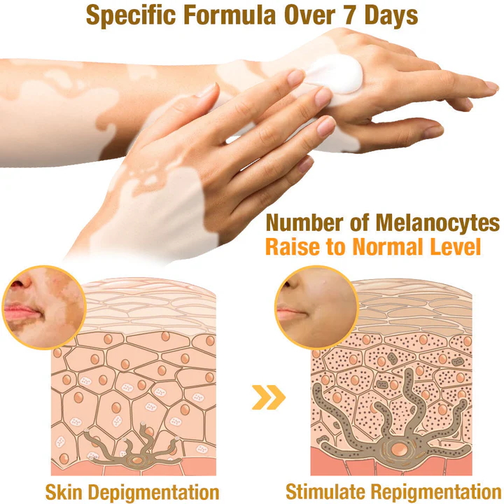 LOVILDS⢠BeeVenom Vitiligo Treatment Cream