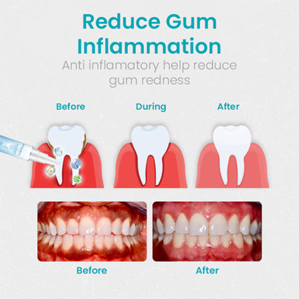 🔥Last Day Promotion 80% OFF-NESLEMY™ Gum Shield Therapy Gel