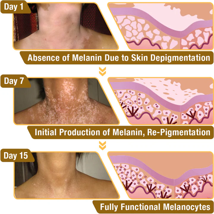 LOVILDS⢠BeeVenom Vitiligo Treatment Cream