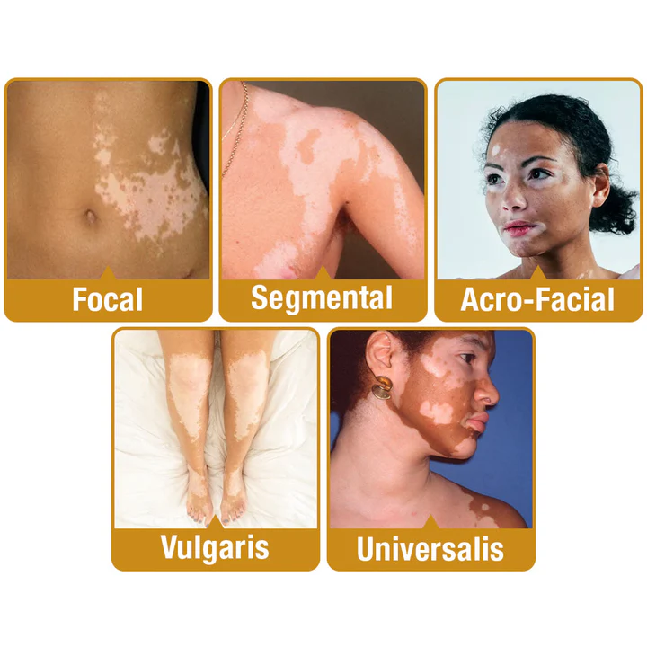 LOVILDS⢠BeeVenom Vitiligo Treatment Cream