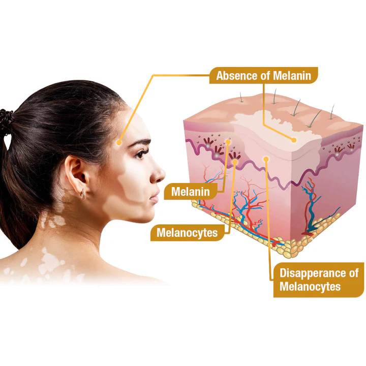 LOVILDS⢠BeeVenom Vitiligo Treatment Cream