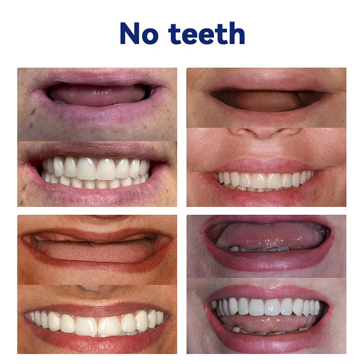 NESLEMY™-🦷Advanced Customized Full Denture Set🦷 (⏰Limited time discount last 30 minutes⏰)