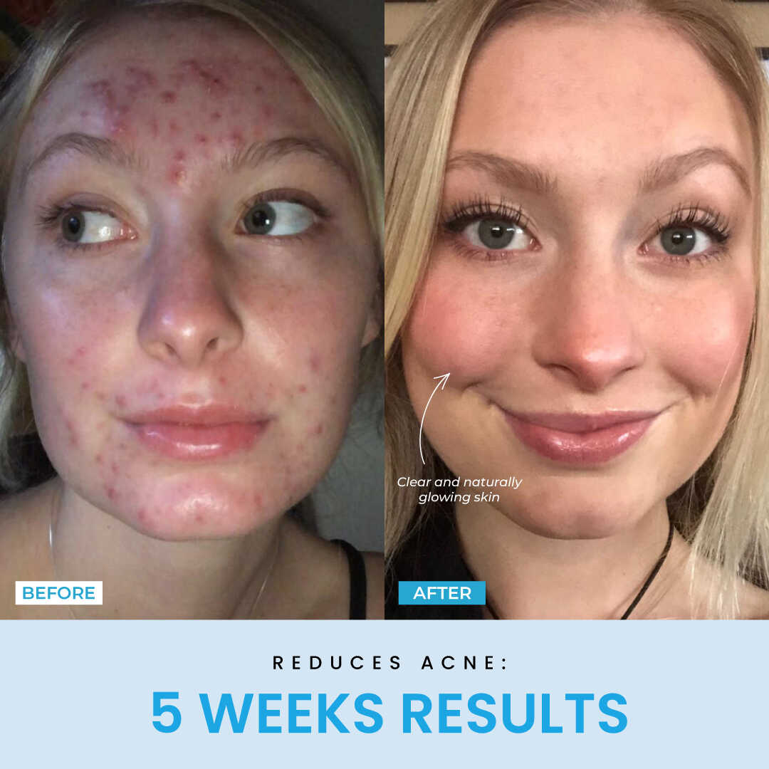 NESLEMY™ Face Sculptor literally + Free Serum