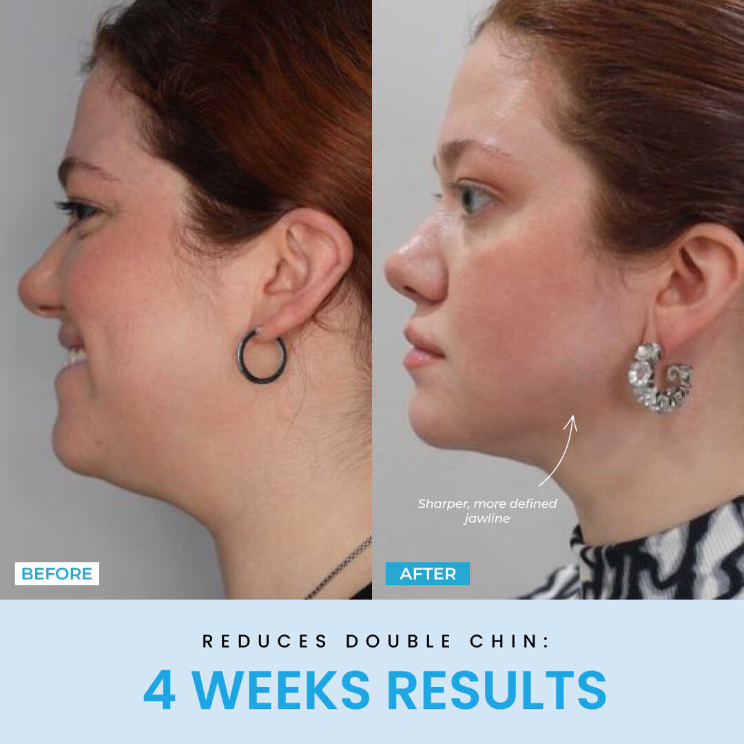 NESLEMY™ Face Sculptor literally + Free Serum
