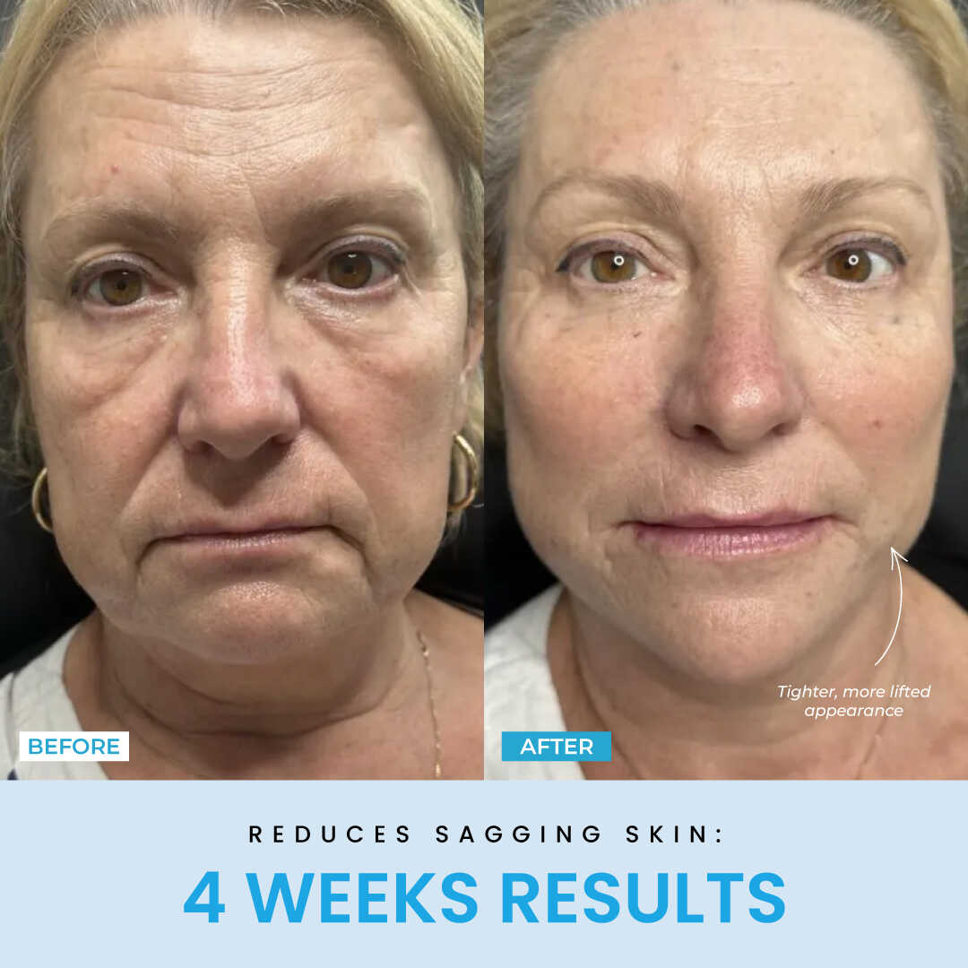 NESLEMY™ Face Sculptor literally + Free Serum