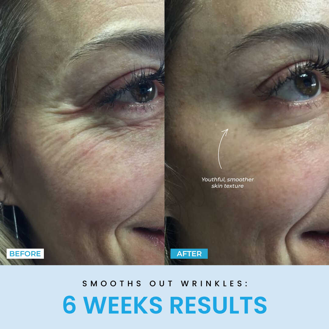 NESLEMY™ Face Sculptor literally + Free Serum