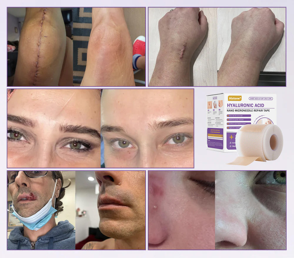 ✅Official Store |Histone® Hyaluronic Acid Nano Microneedle Repair Tape🍁🏥(Treatment of old and new scars, reduction of surgical scars, stretch marks, keloids, acne, burns, warts, dermatomes and varicose veins)