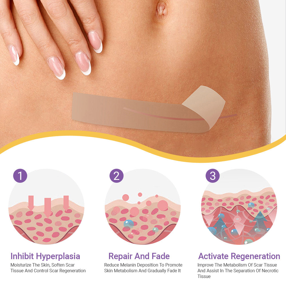 ✅Official Store |Histone® Hyaluronic Acid Nano Microneedle Repair Tape🍁🏥(Treatment of old and new scars, reduction of surgical scars, stretch marks, keloids, acne, burns, warts, dermatomes and varicose veins)