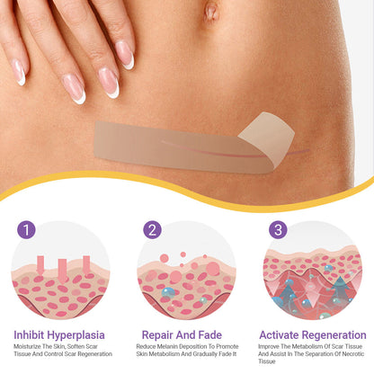 ✅Official Store |Histone® Hyaluronic Acid Nano Microneedle Repair Tape🍁🏥(Treatment of old and new scars, reduction of surgical scars, stretch marks, keloids, acne, burns, warts, dermatomes and varicose veins)