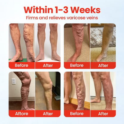 Lovilds™ VeinLess Immediate Relief Herbal Patch -✅ Clinically proven to eliminate varicose veins in just 7 days!