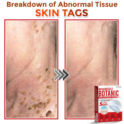 🌈LOVILDS® MicroNeedle Botanic Skin Tag Removal Patch 🇺🇸 Made in the USA
