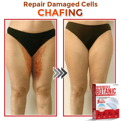 🌈LOVILDS® MicroNeedle Botanic Skin Tag Removal Patch 🇺🇸 Made in the USA