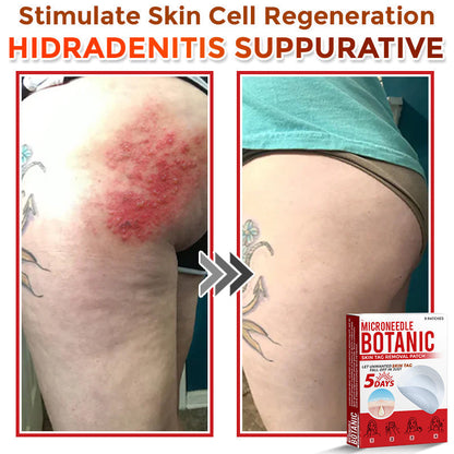 🌈LOVILDS® MicroNeedle Botanic Skin Tag Removal Patch 🇺🇸 Made in the USA