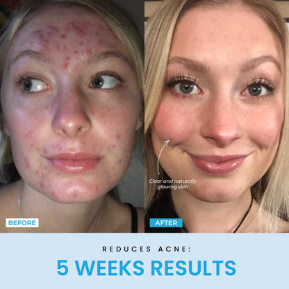 NESLEMY™ Face Sculptor literally + Free Serum